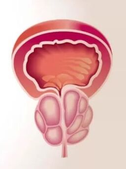 Inflamarea prostatei