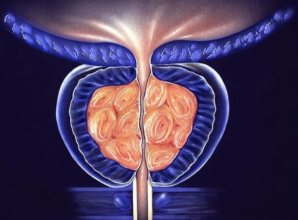 Prostatită bacteriană cronică la bărbați